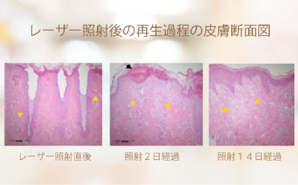 レーザーで微細な点状の孔をあけて新しい皮膚の再生を促進し肌トラブルを改善