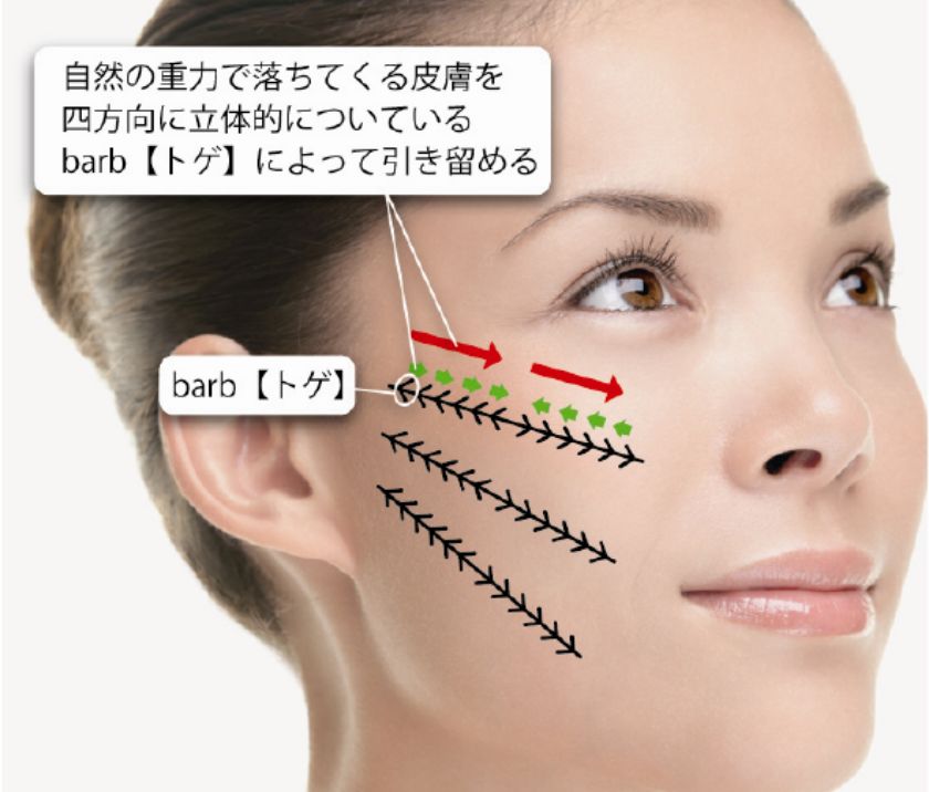 広島の糸リフト「リードファインリフト4D」