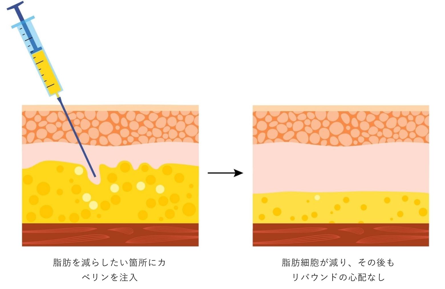 広島の小顔「輪郭注射」脂肪細胞をケア