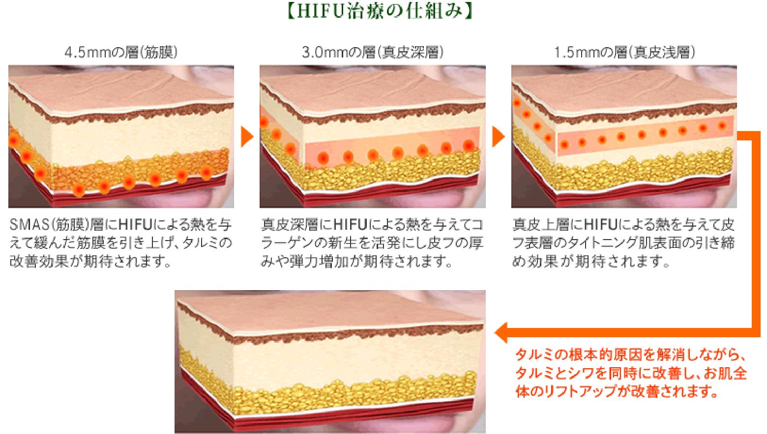 広島のほうれい線治療HIFU（ハイフ）顔全体をリフトアップ