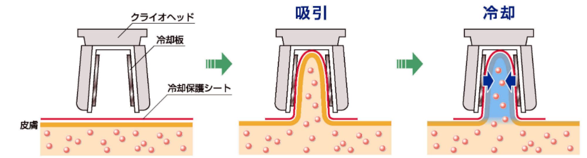 広島の痩身キャビ・クライオ（脂肪冷却）で脂肪を破壊